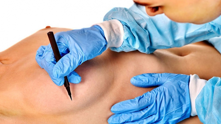 Tratamientos-Quirurgicos-Mastopexia-con-aumento Mamoplastia de reducción