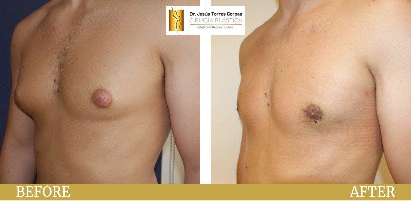 ginecomastia masculina