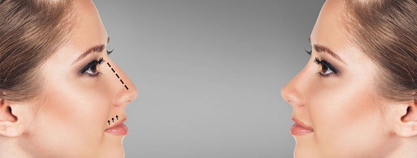 Comparación de perfil nasal utilizada para explicar una rinoplastia