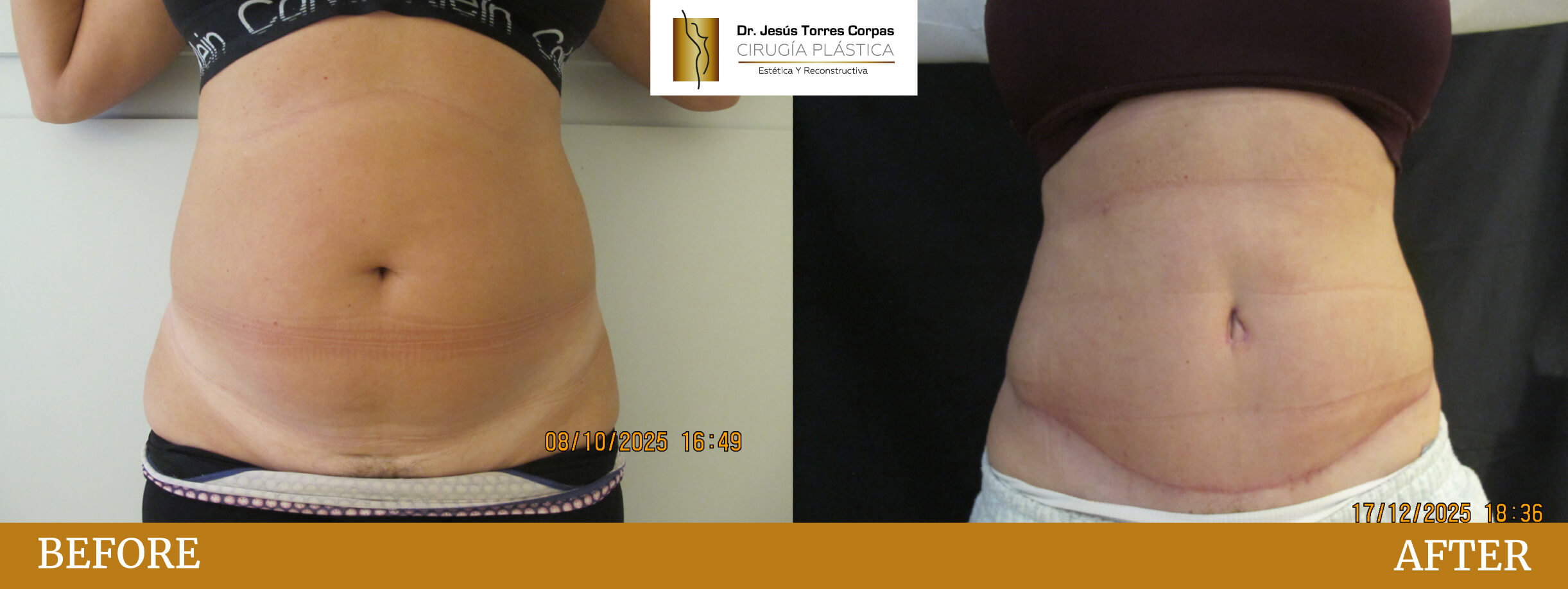antes-despues-2026_ABDOMINOPLASTIA-1