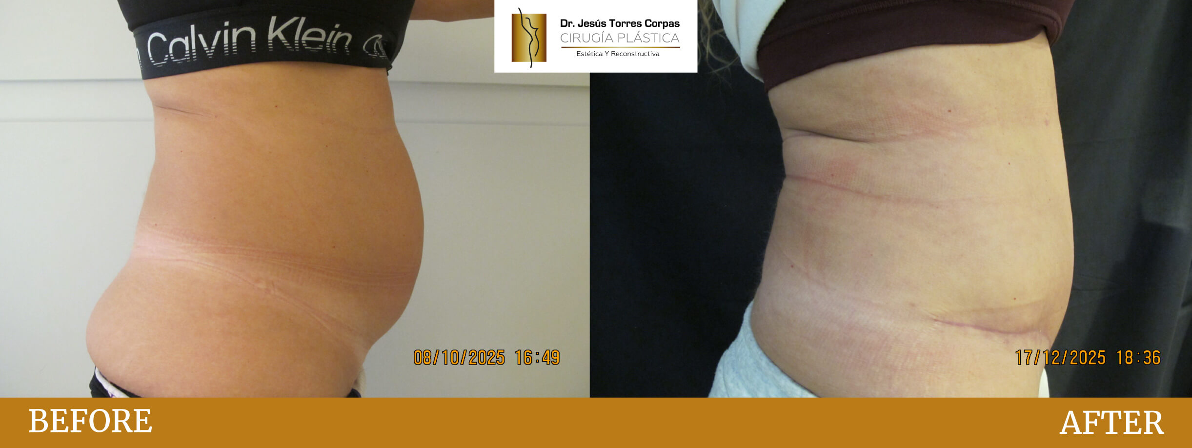 antes-despues-2026_ABDOMINOPLASTIA-2