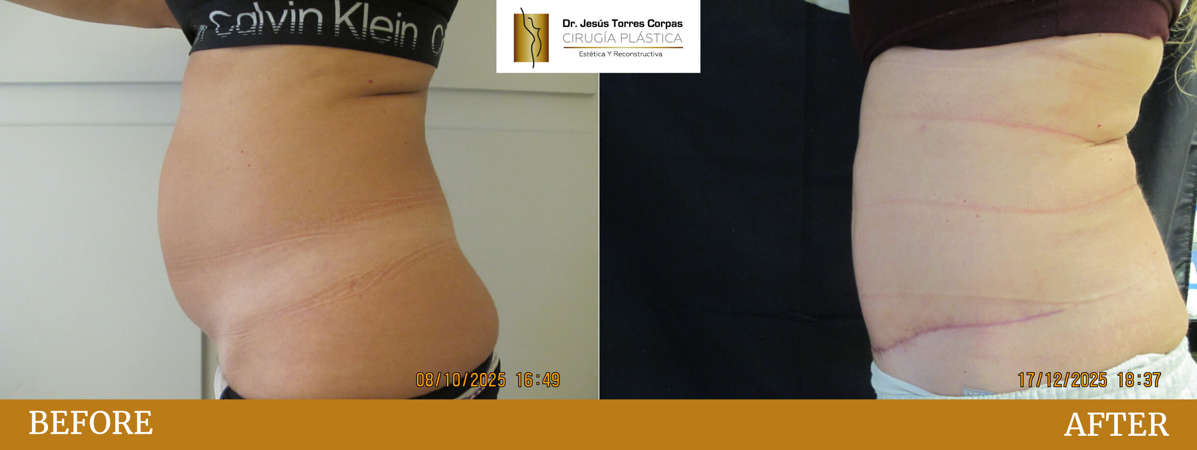 antes-despues-2026_ABDOMINOPLASTIA-3