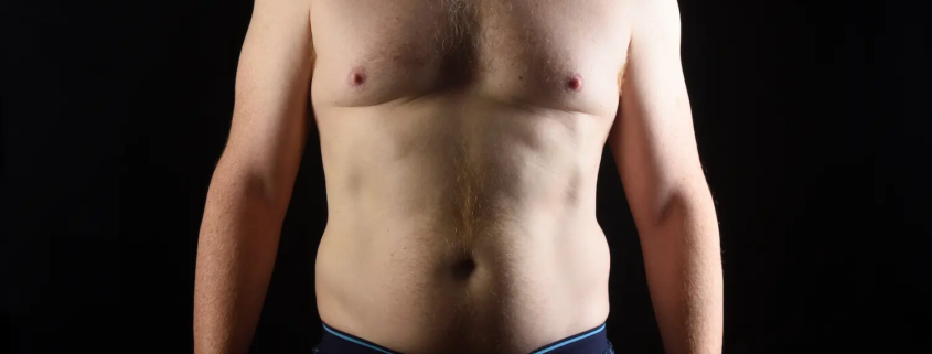 Ginecomastia masculina