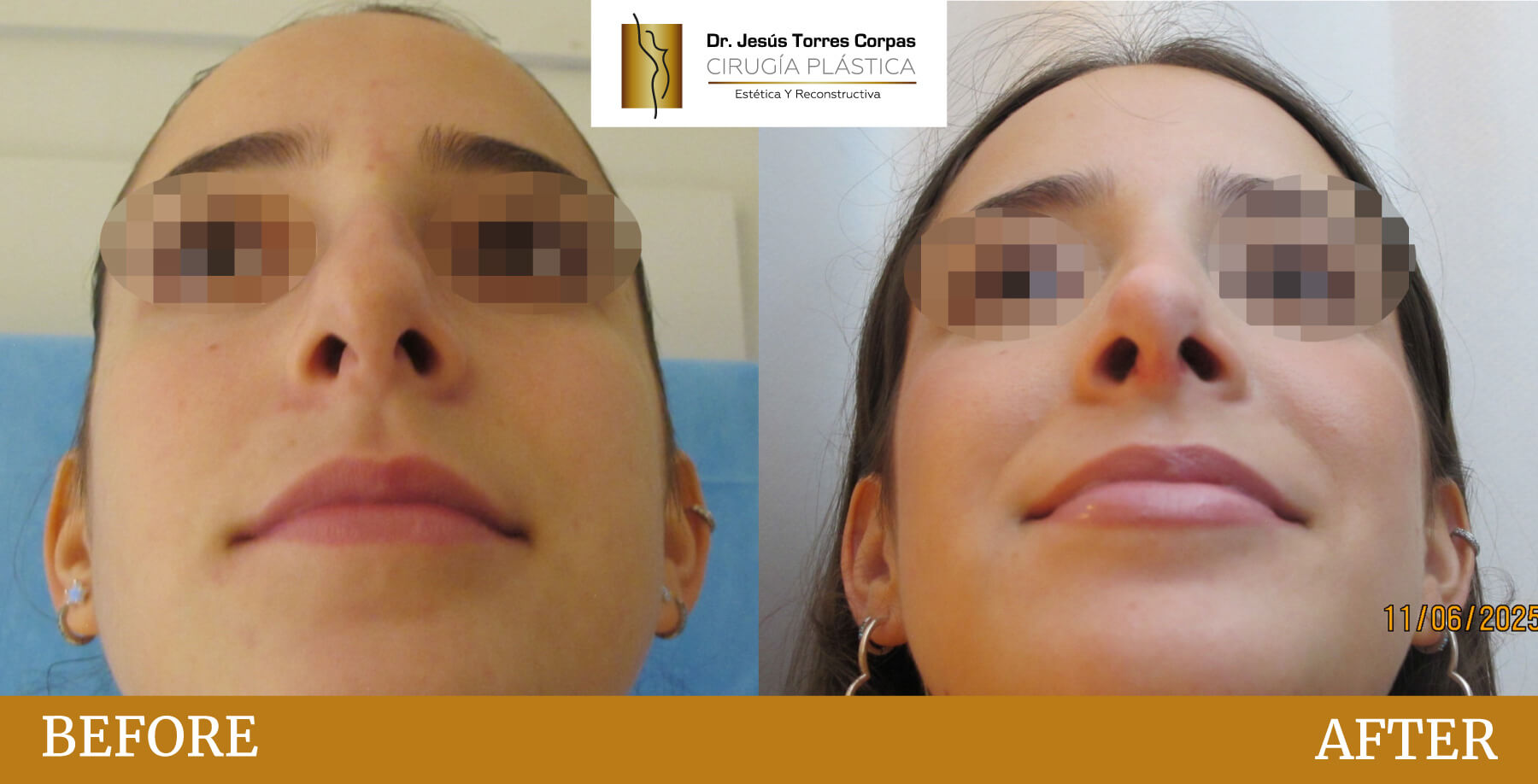 antes-despues-2026_rinoplastia-B