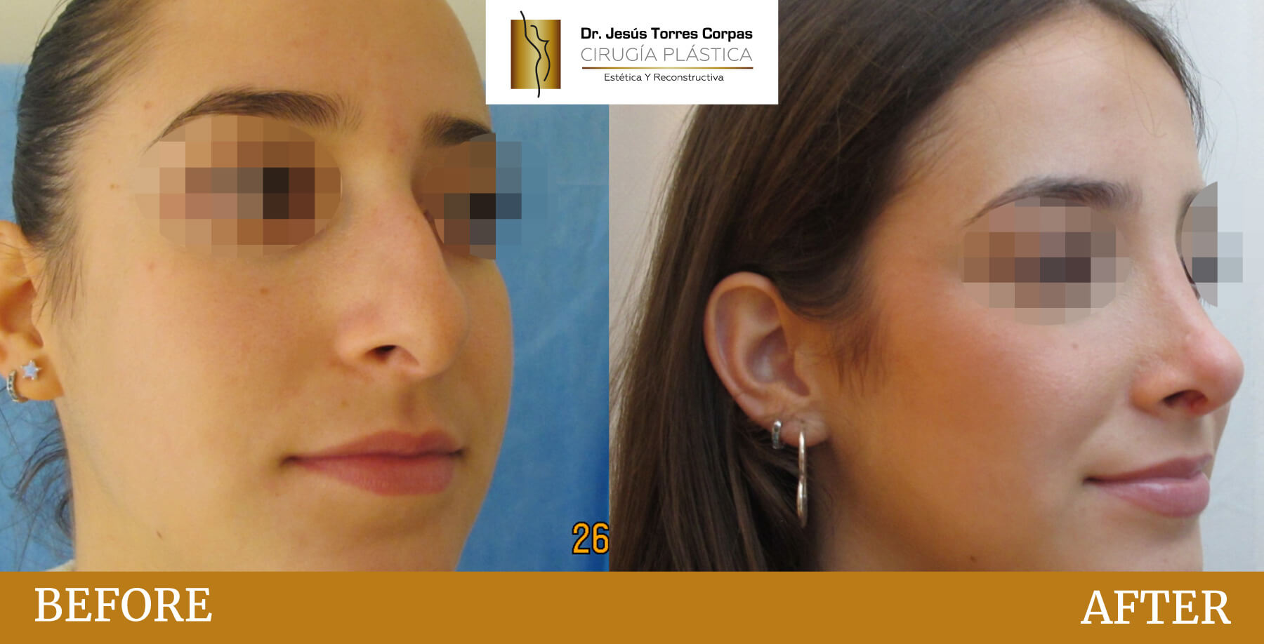 antes-despues-2026_rinoplastia-C