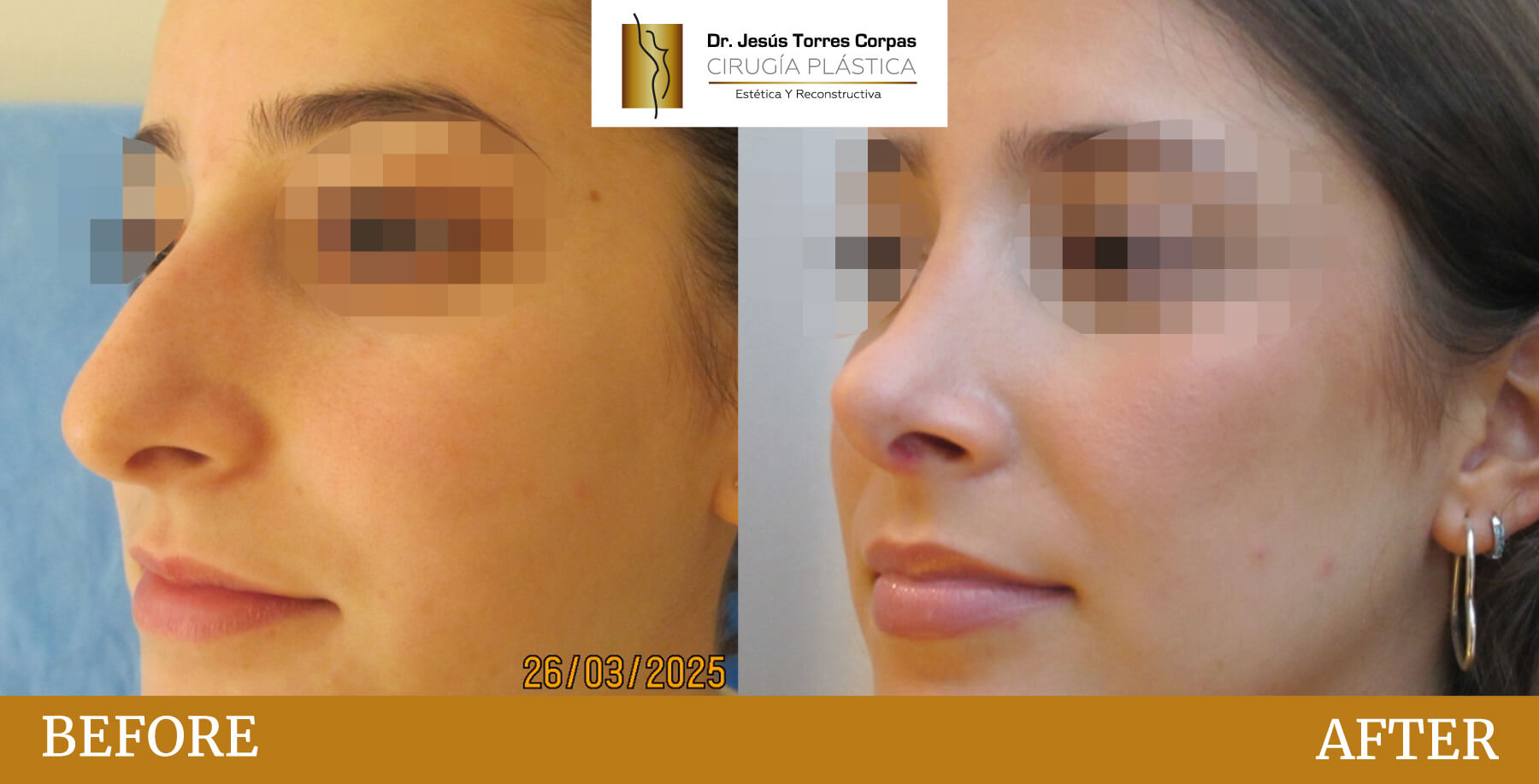 antes-despues-2026_rinoplastia-D