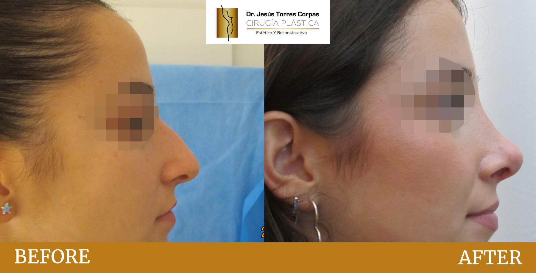 antes-despues-2026_rinoplastia-F