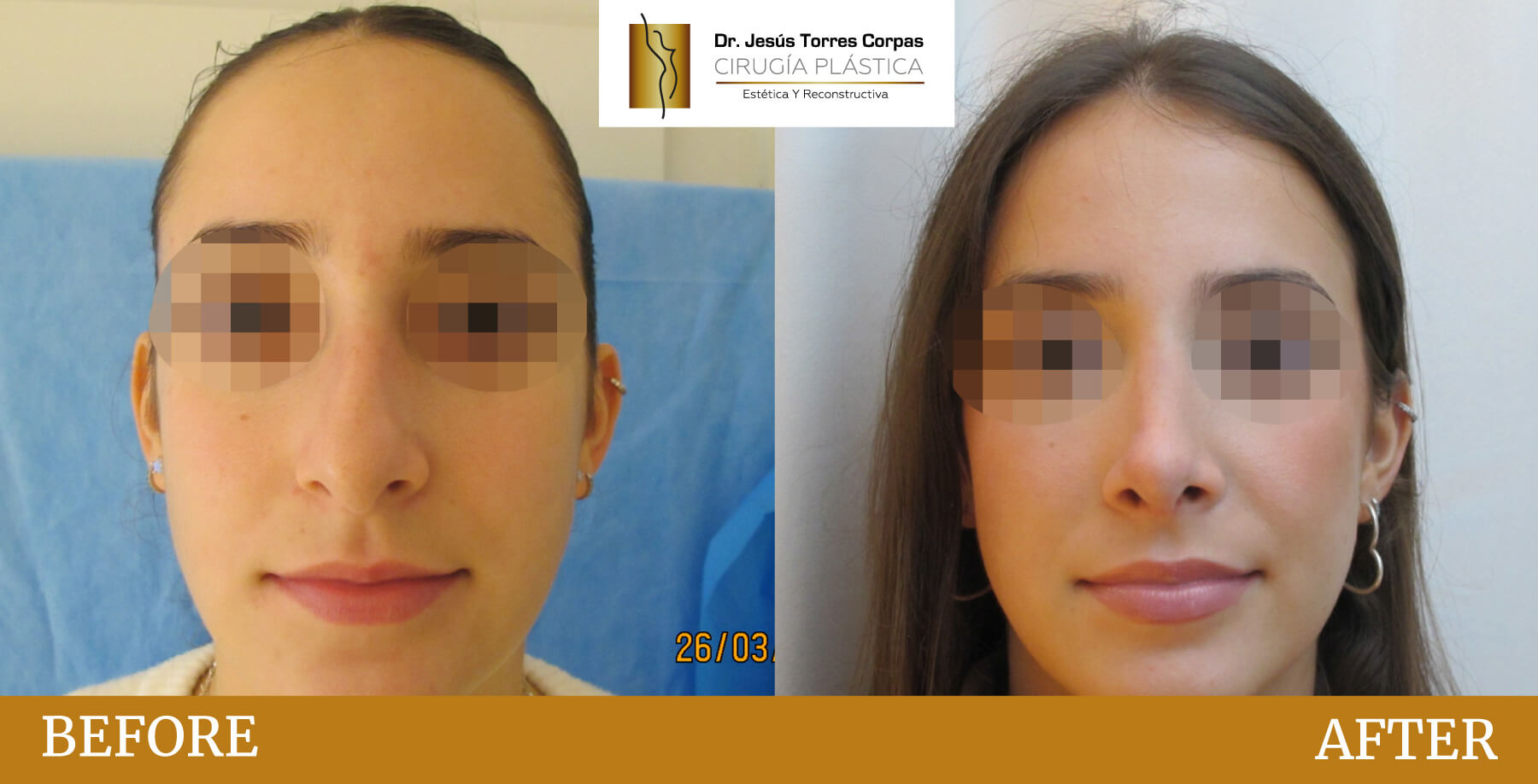 antes-despues-2026_rinoplastia-a