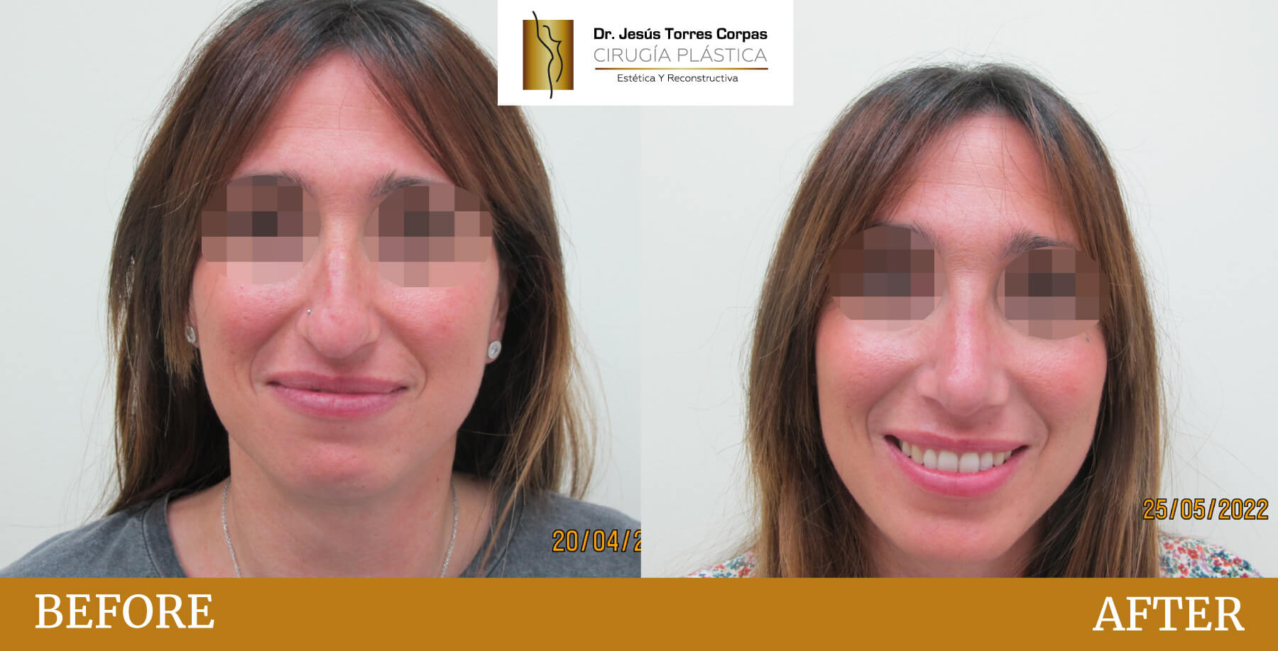 antes-despues-2026_rinoplastia_2_A