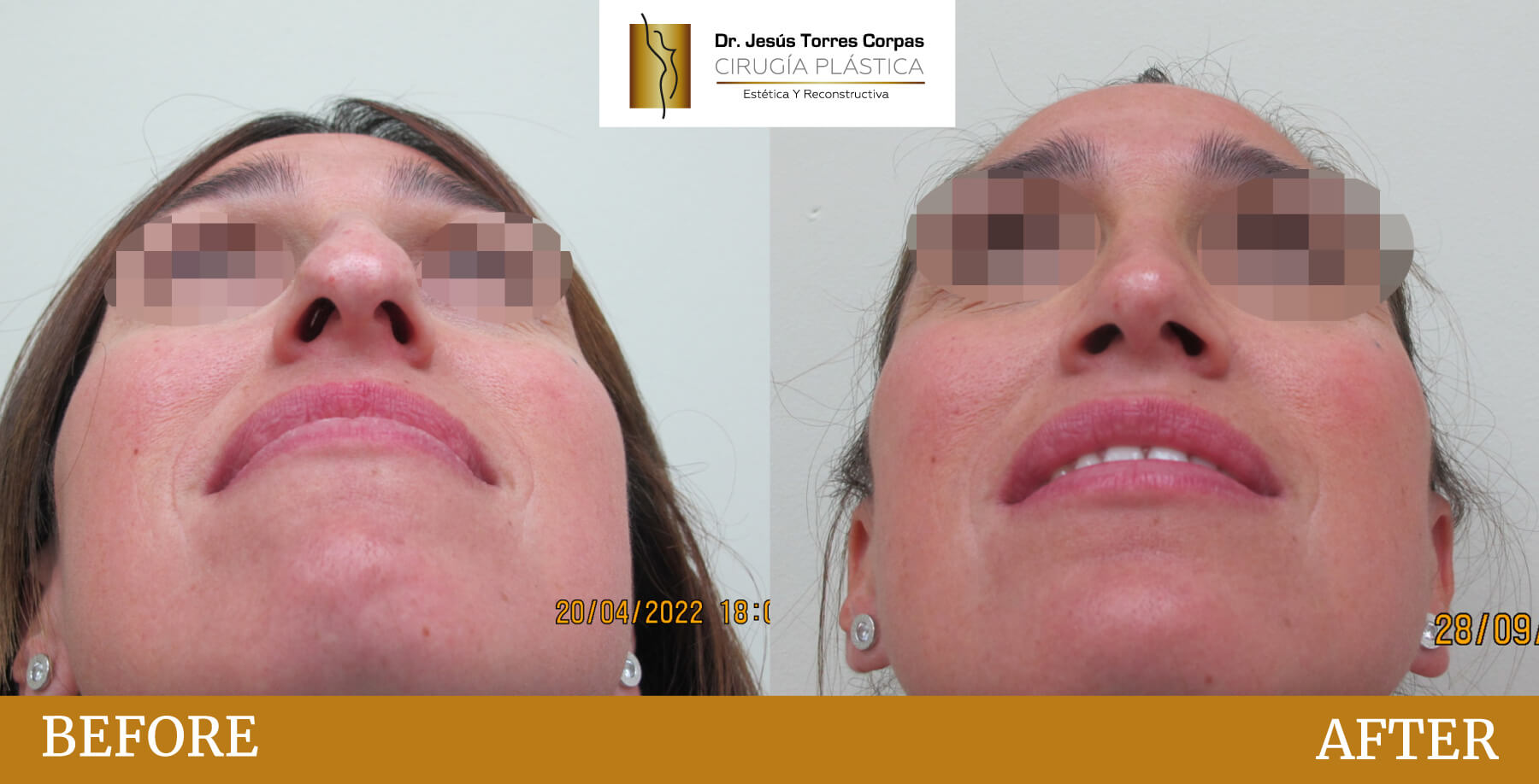 antes-despues-2026_rinoplastia_2_B