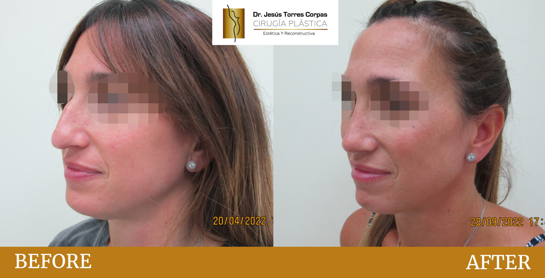 antes-despues-2026_rinoplastia_2_D