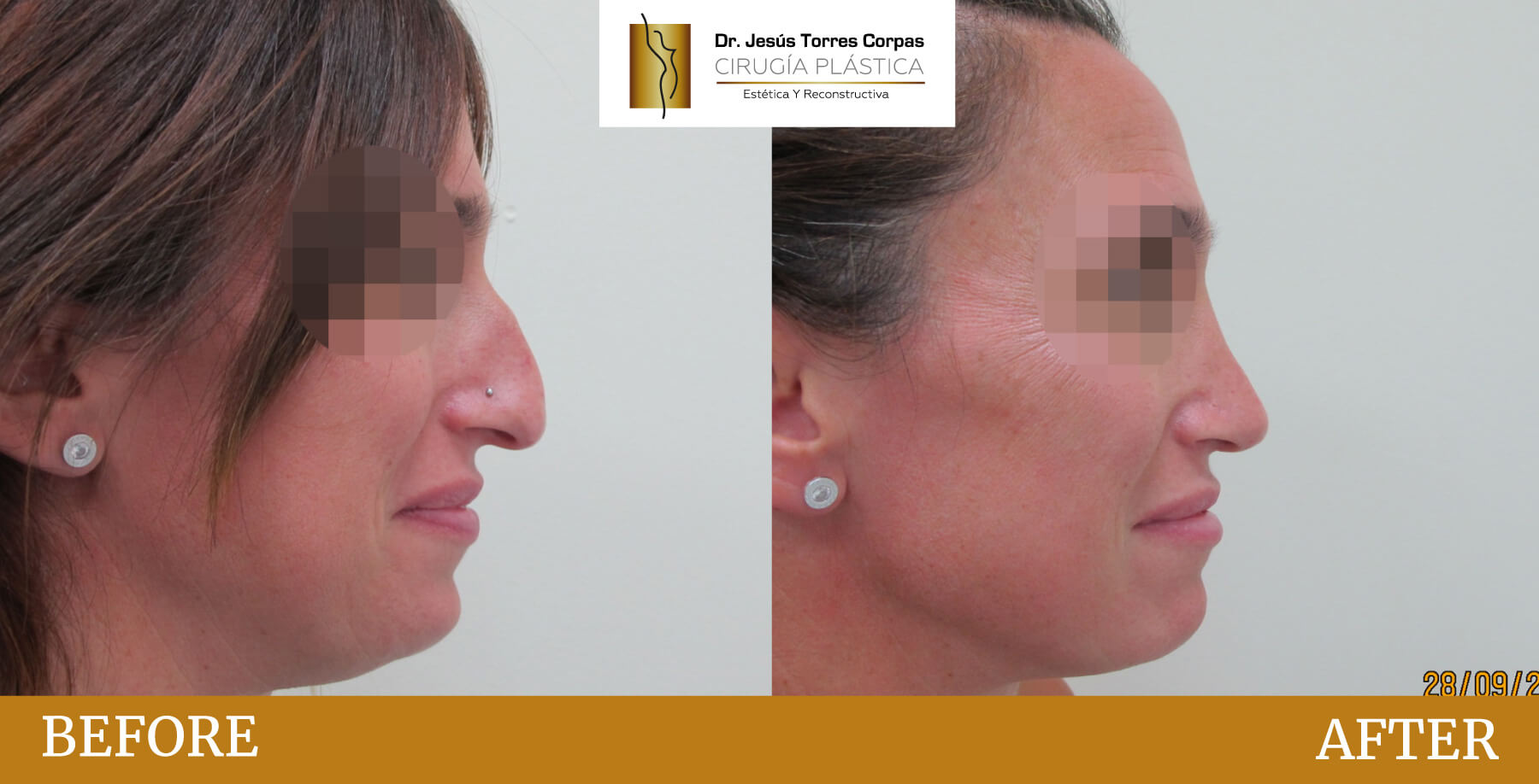 antes-despues-2026_rinoplastia_2_E