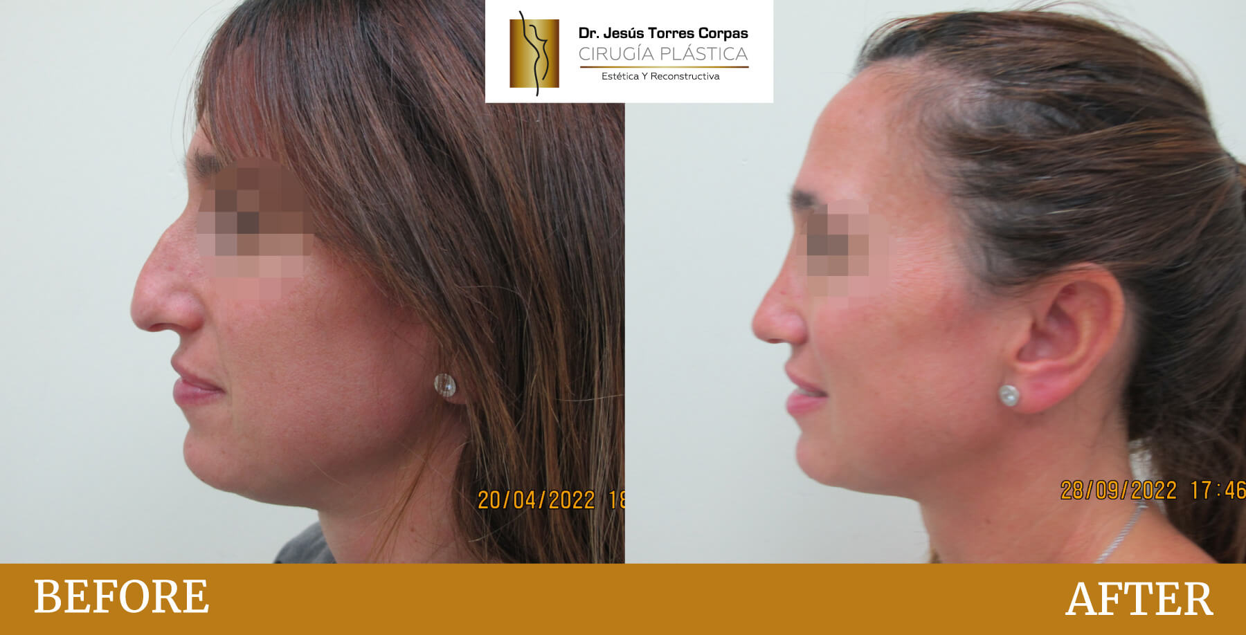 antes-despues-2026_rinoplastia_2_F