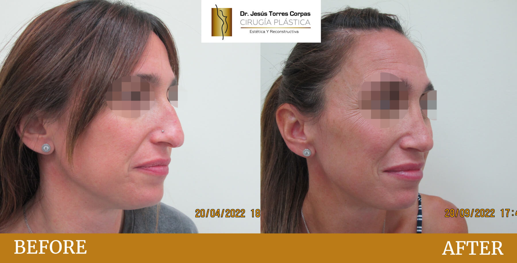 antes-despues-2026_rinoplastia_2_c