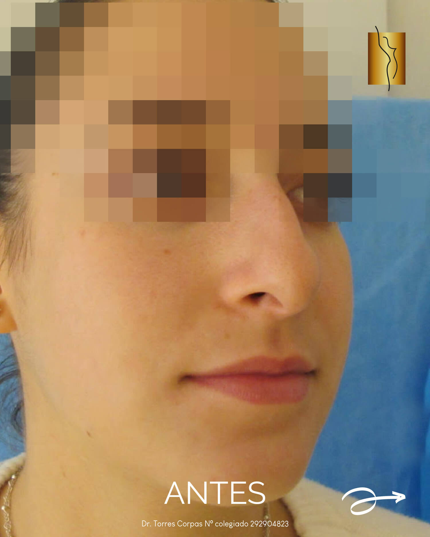 rinoplastia-preservacion_polygon-tip---antes-y-despues-02