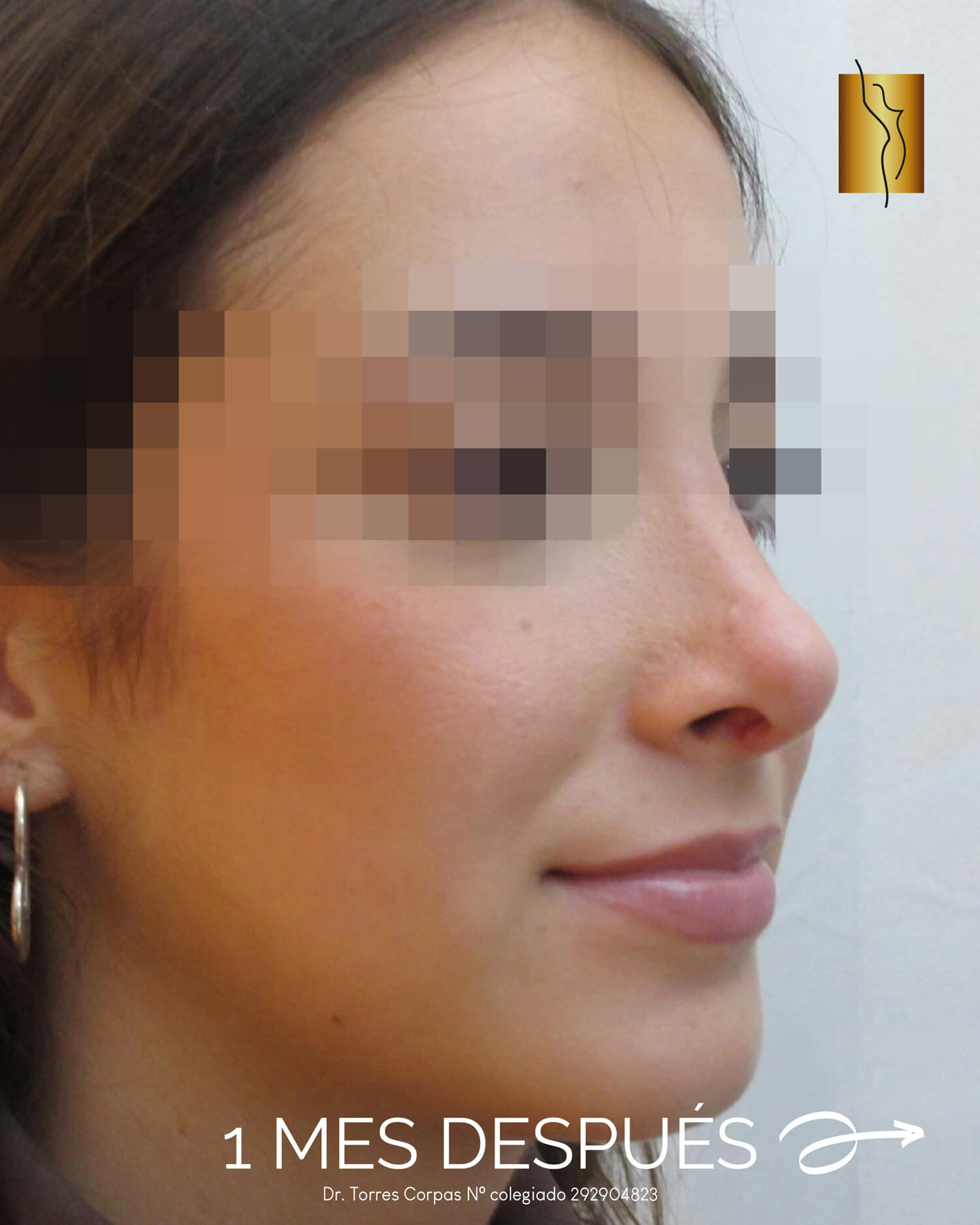 rinoplastia-preservacion_polygon-tip---antes-y-despues-03