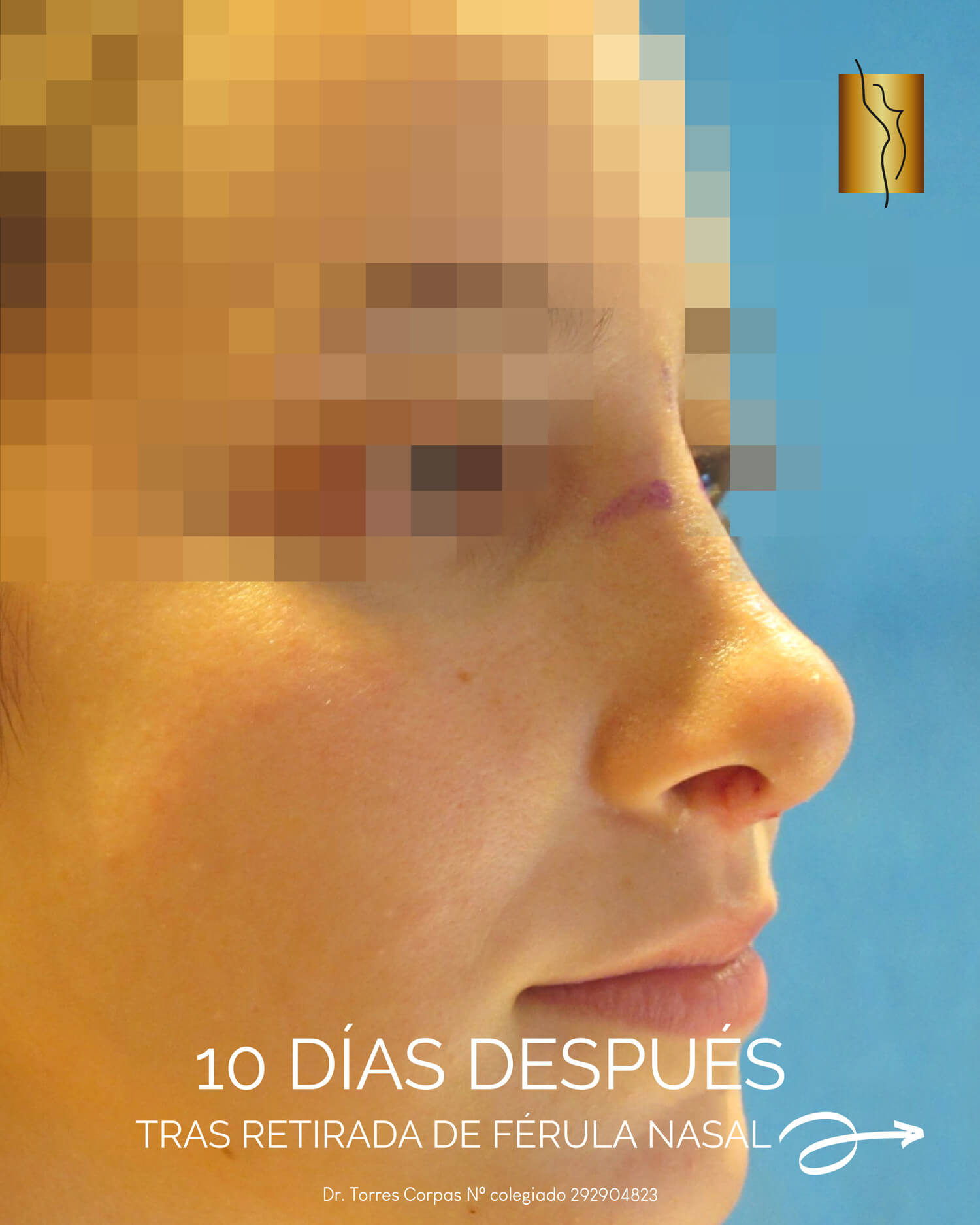 rinoplastia-preservacion_polygon-tip---antes-y-despues-04